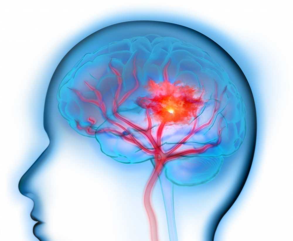 Stroke Timely emergency treatment for cerebral infarction is essential for survival / Health News