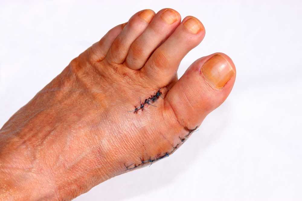 Bad hammertoe pain due to high heels in women / Health News