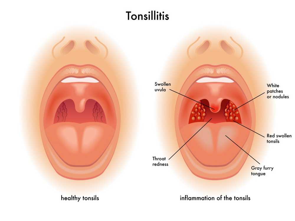 Difficulty swallowing problems