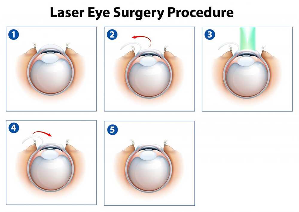 Seeing without glasses - LASIK or lens What is better? / Health News