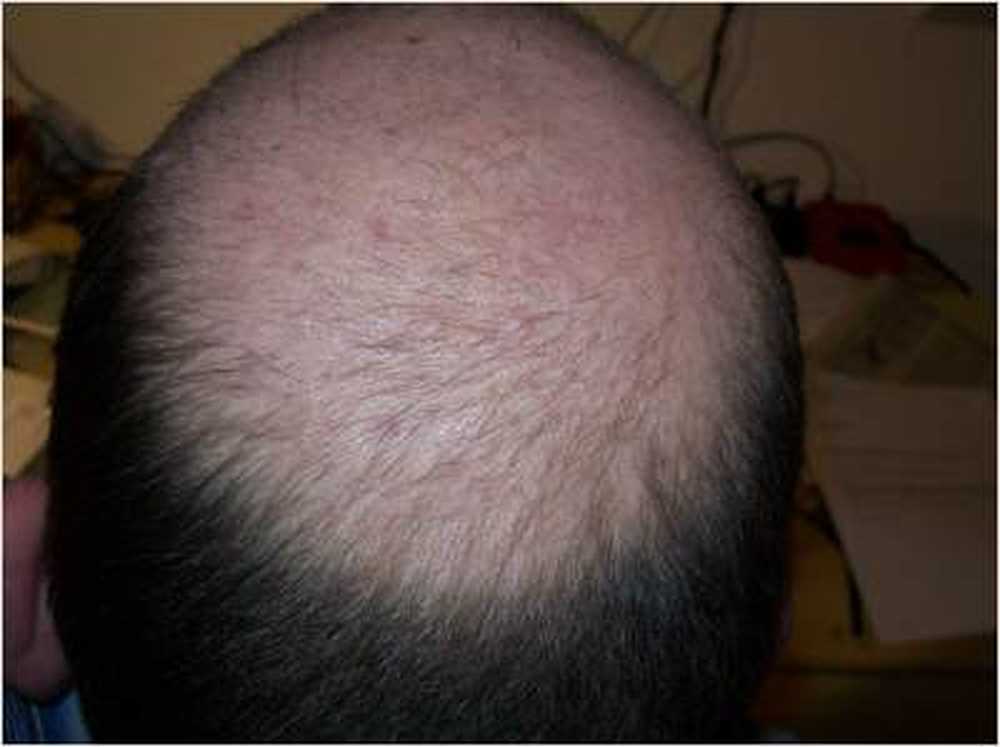 So stop the hair loss / Health News