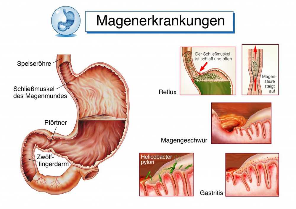 Heartburn causes, treatment and home remedies for acid regurgitation / Health News