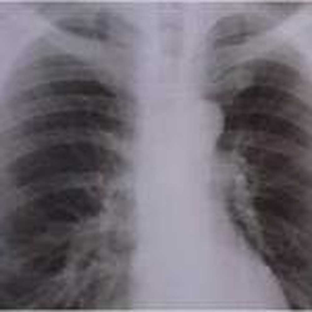 Long-term effects of smoking More lung cancer cases / Health News