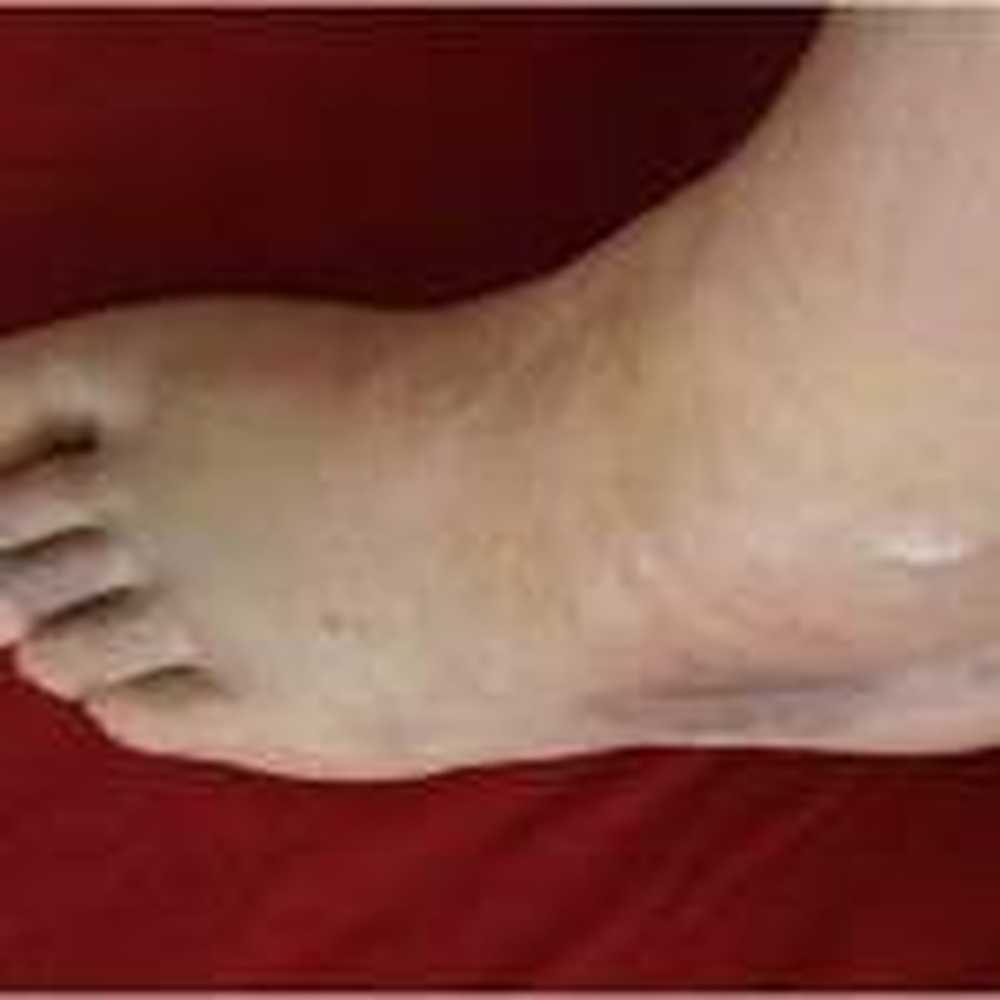 Shockwave therapy for heel pain / Health News