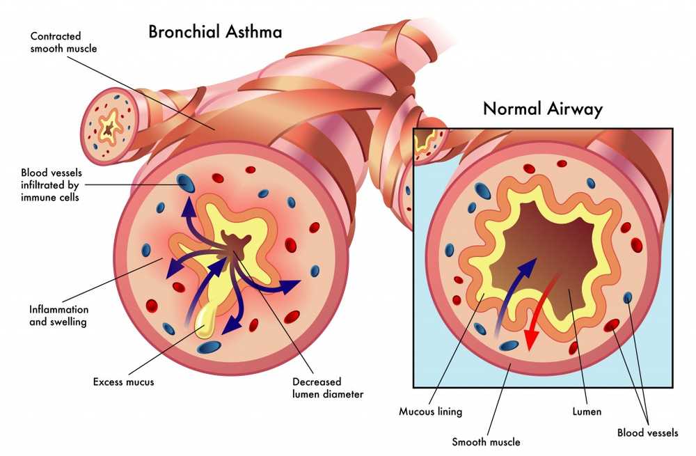 Un médicament détecté soulage l'asthme allergique