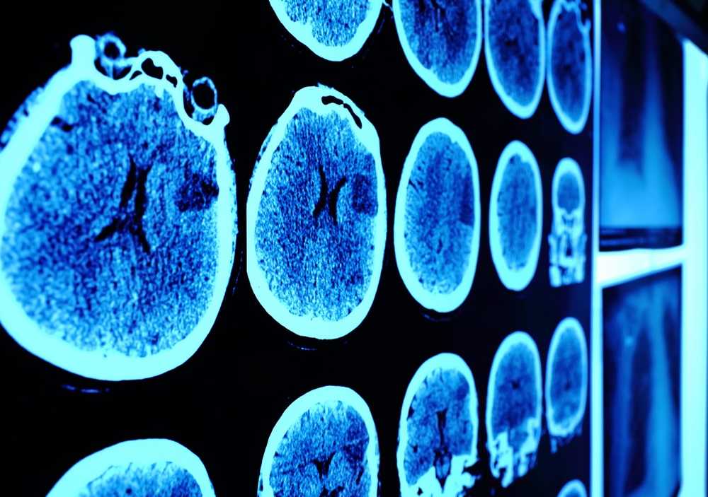 Studi Le cellule della pelle trasformate uccidono le cellule tumorali / Notizie di salute