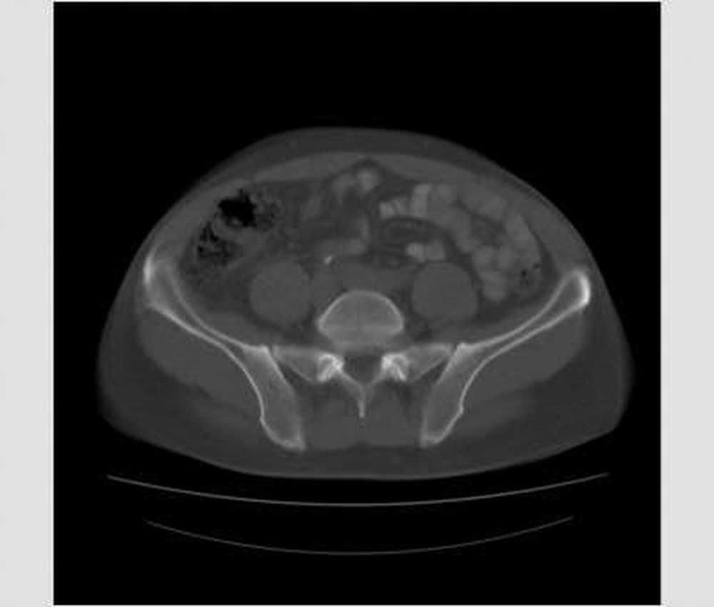 Stool transplants in case of severe diarrhea / Health News