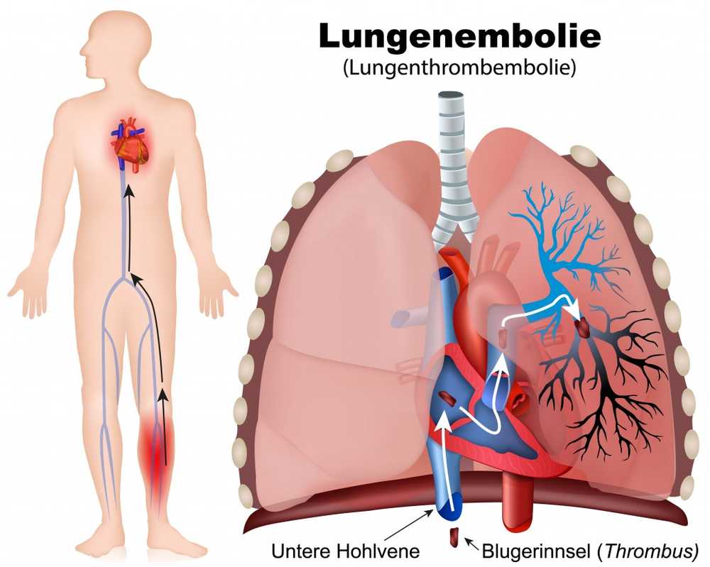 La persistencia frente al televisor durante horas puede causar una embolia pulmonar / Noticias de salud