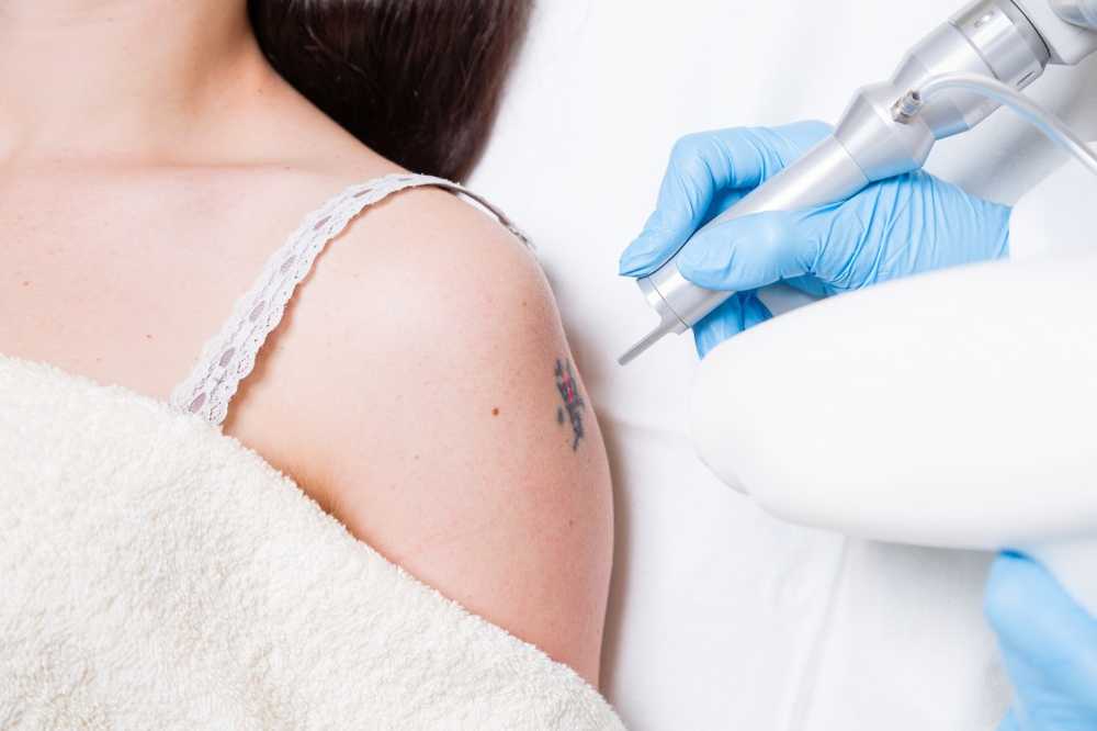 Tattoo removal with toxic hydrocyanic acid is associated with great health risks / Health News