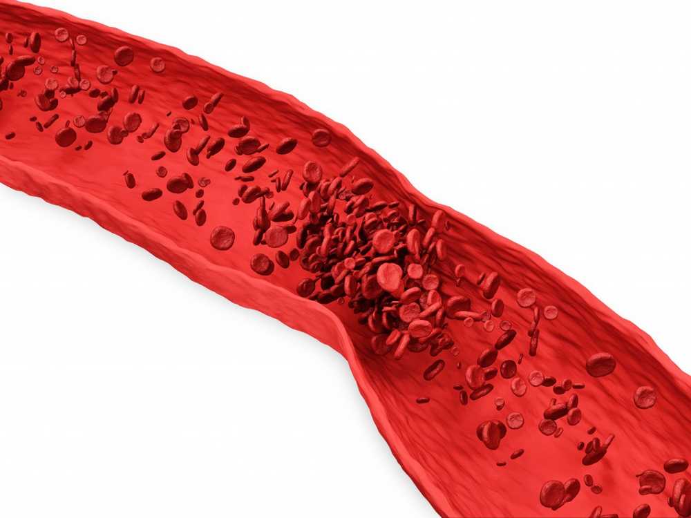 Thrombosis grafting in the veins is life threatening / Health News