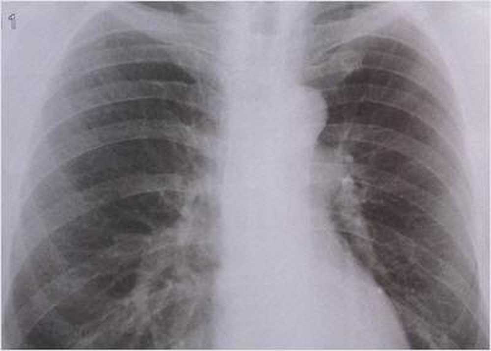 Tuberculose en baisse dans toute l'Europe / Nouvelles sur la santé