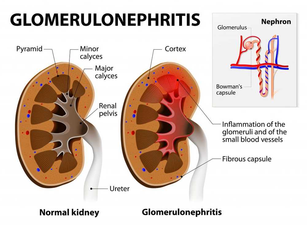 Causa de enfermedad renal identificada en pacientes con cáncer. / Noticias de salud