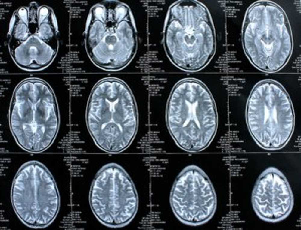 Supposed tumor at surgery was a twin in the brain of a woman / Health News