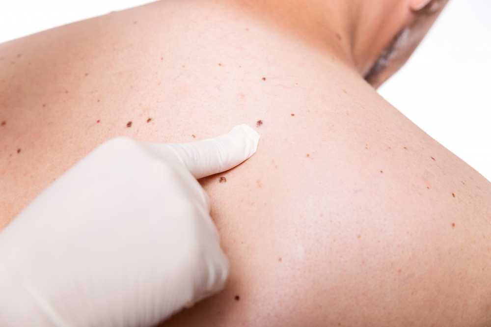 Many liver spots on the right arm indicate a risk of skin cancer