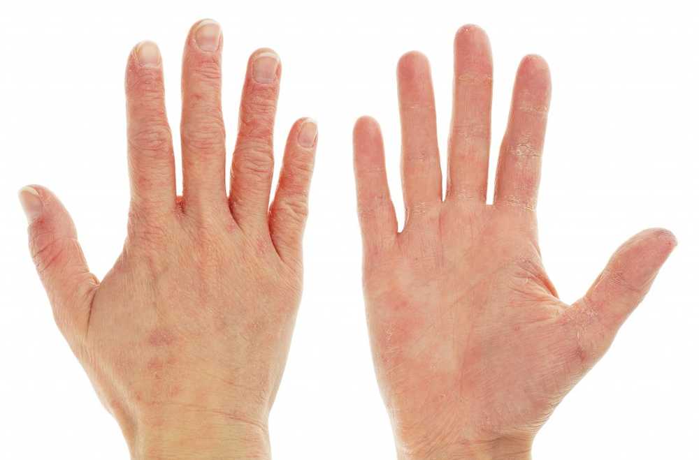 Pay attention to the warning signals At the first symptoms of contact dermatitis, see the doctor quickly / Health News