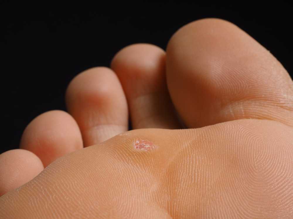 Warts advice In warts, plucking, scratching, pounding or rubbing must be taboo / Health News