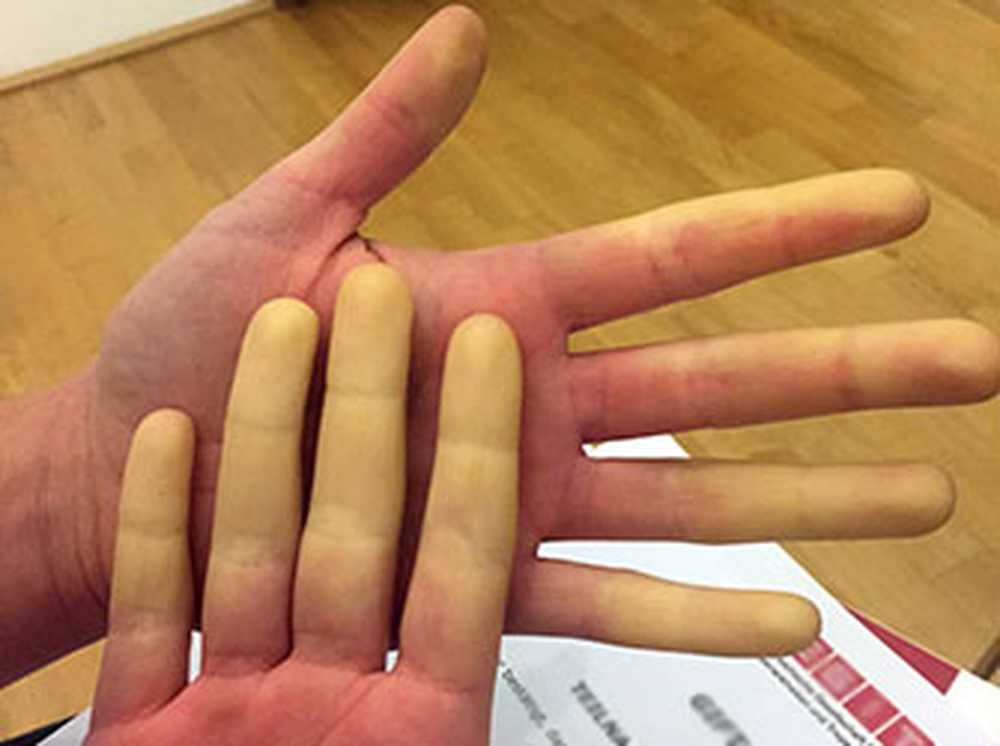 Vita fingrar Skadligt symptom eller tecken på allvarlig sjukdom? / Hälsa nyheter