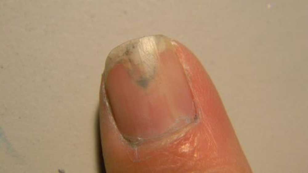 White spots on the fingernails