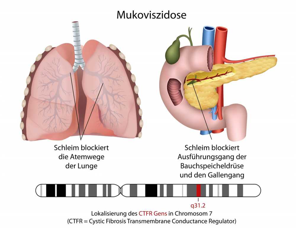 Che tipo di aiuto terapeutico hanno bisogno i bambini con fibrosi cistica? / Notizie di salute