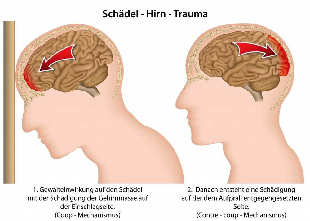 Science suicide risk dramatically increased by concussions