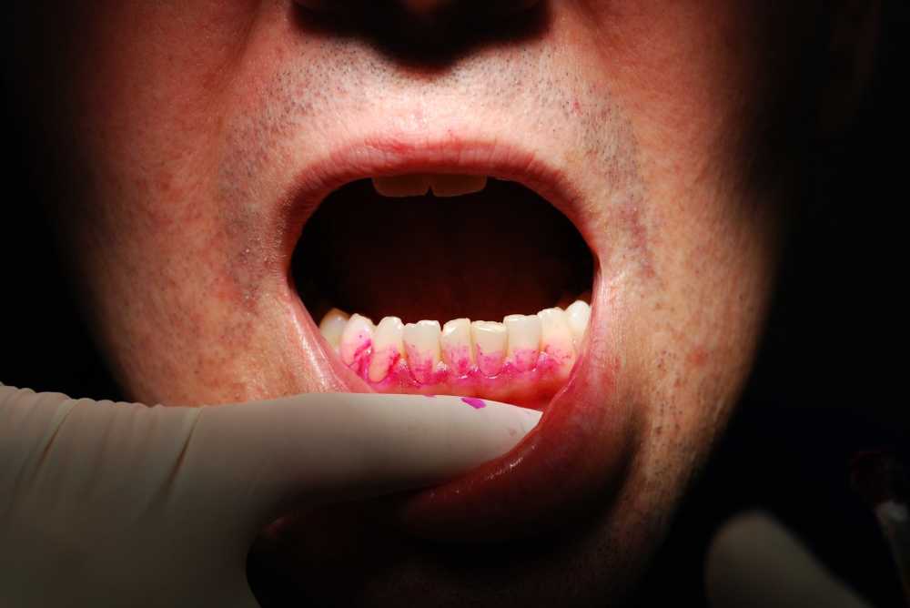 Bleeding gums and bad breath may indicate periodontitis