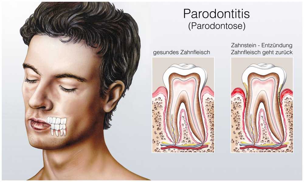 Gingivitis Roken verhoogt het risico op kiespijn / Gezondheid nieuws