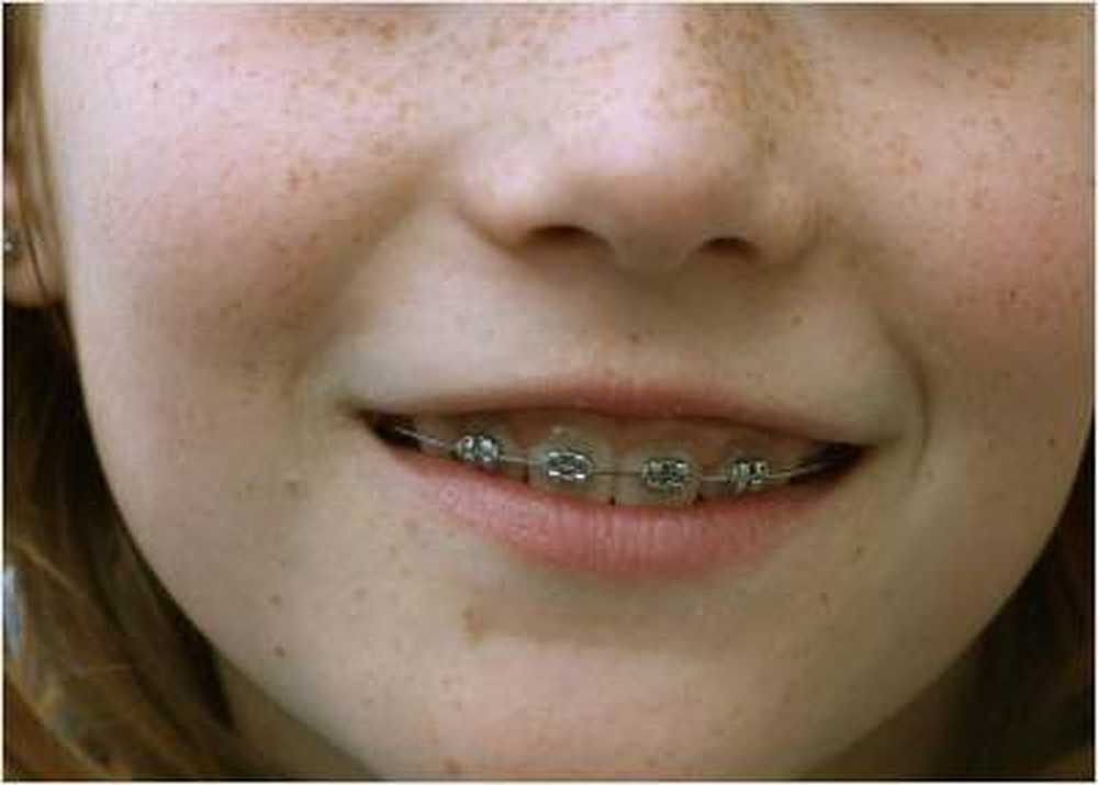 Braces forced parents to co-payments