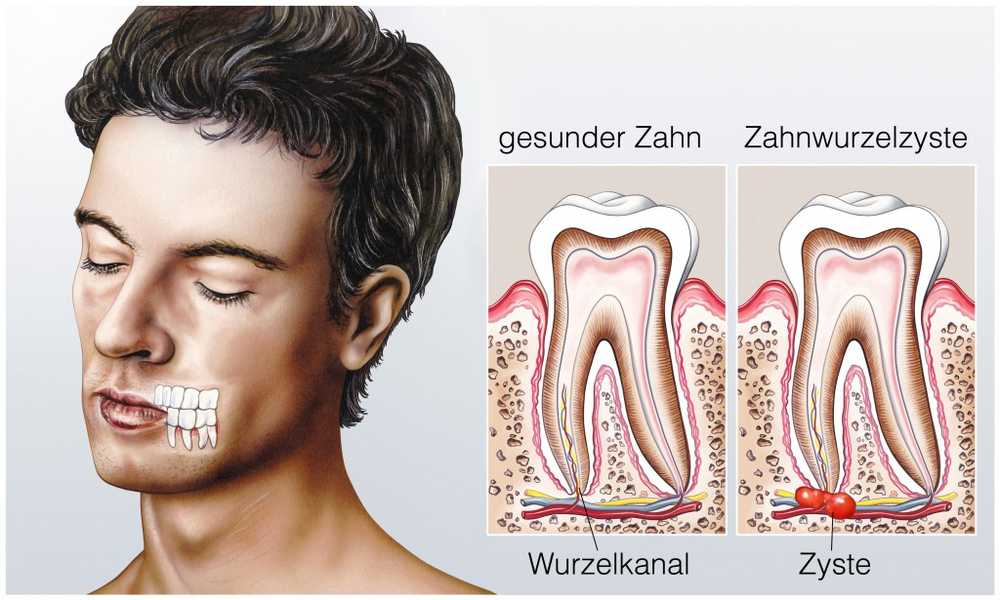 Kyste dentaire - causes et traitement