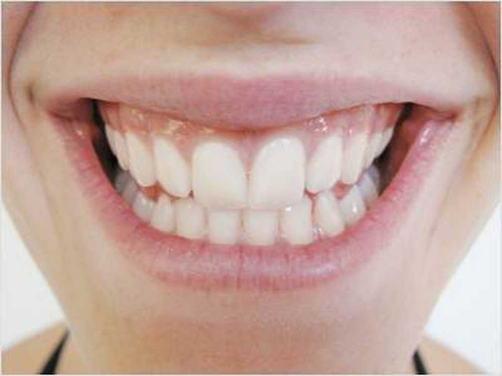 Dents Veneers rend les zones décolorées plus légères