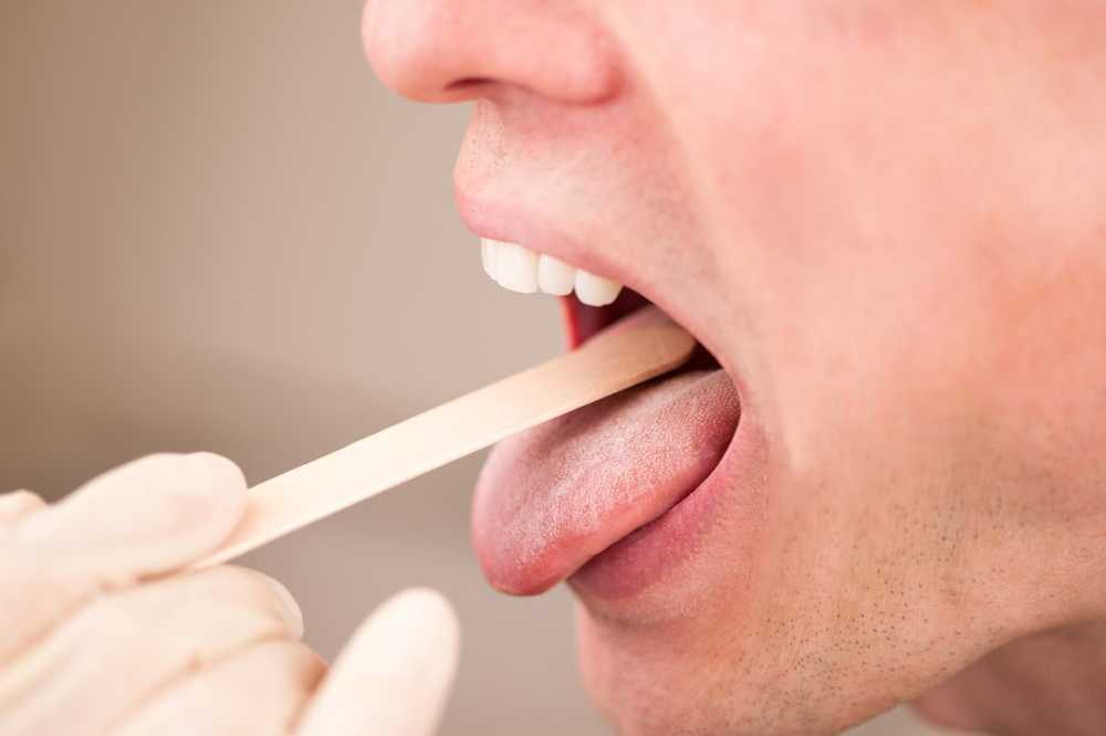 Cause e trattamento del fungo della lingua
